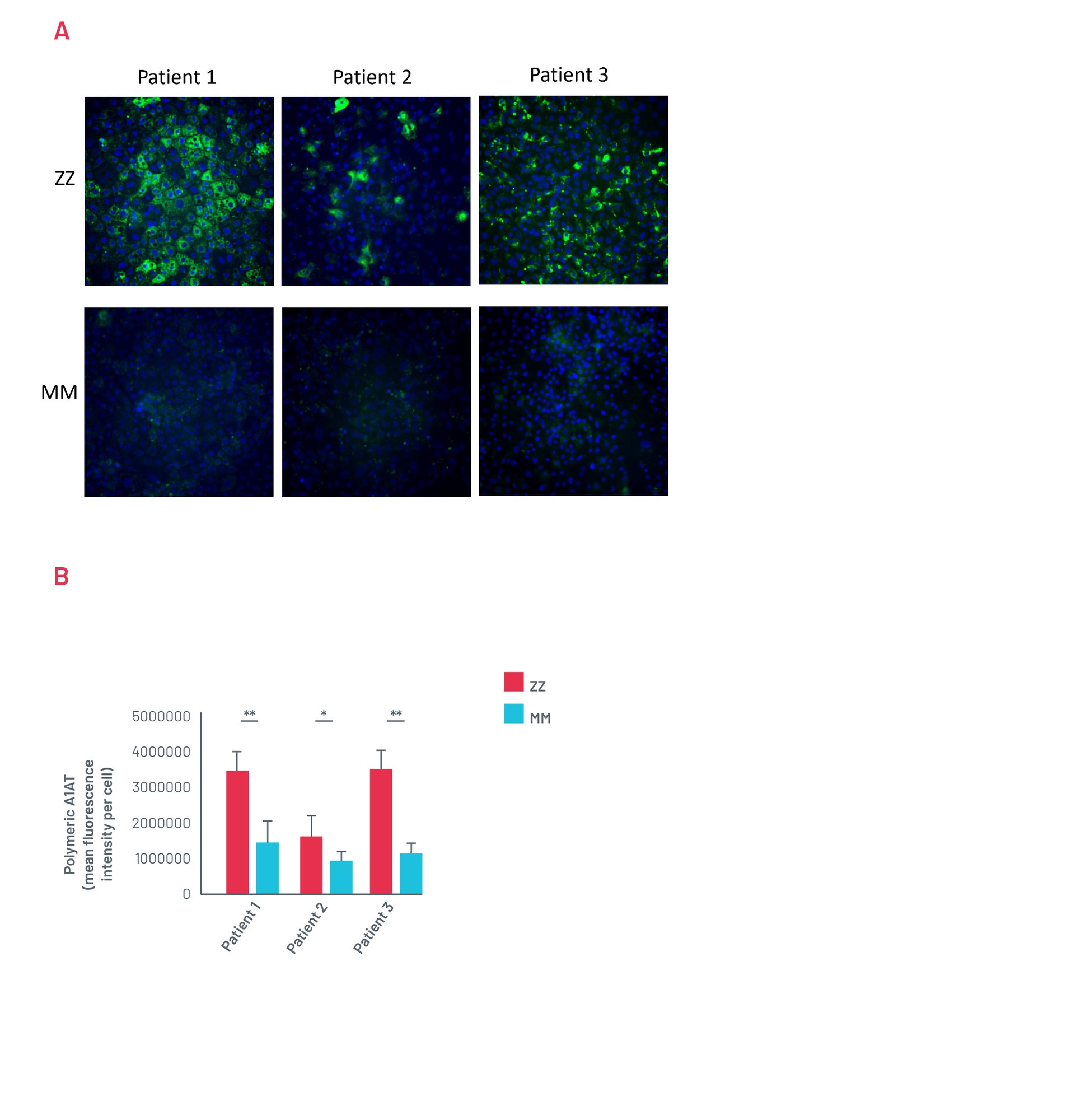 case study alpha 1 antitrypsin deficiency